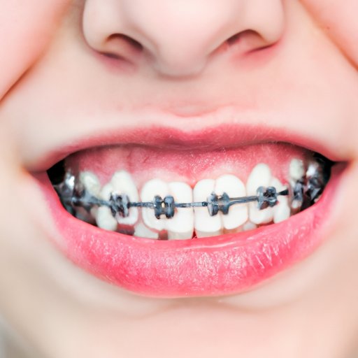 5 Surprising Ways You Can Get Your Braces Removed for Free