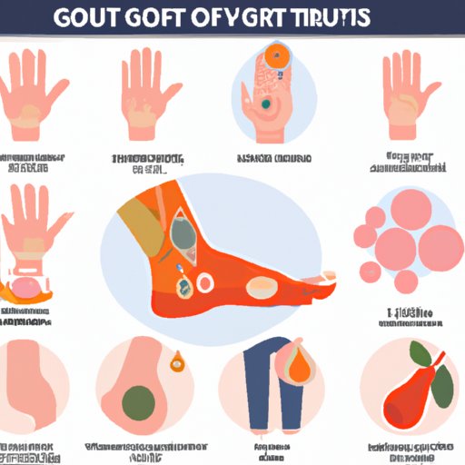 How Do You Know If You Have Gout Symptoms, Risk Factors, and Treatment